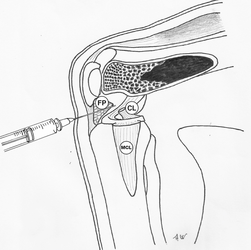 Aspiration or injection of the knee joint GPnotebook