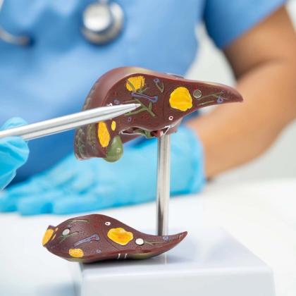 A medical professional points to a detailed liver model showing internal structures and yellow deposits.
