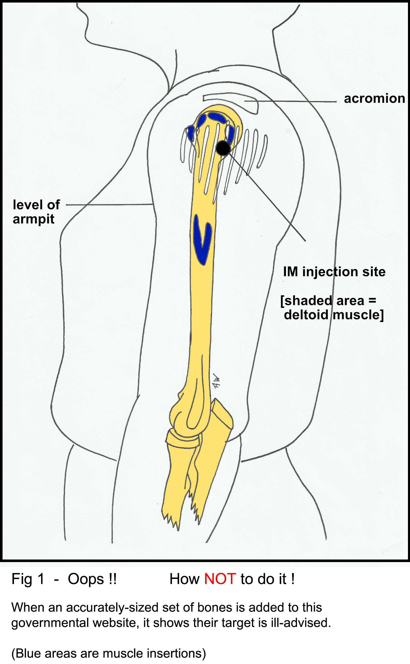 Illustration showing human upper body anatomy with focus on deltoid muscle and proper intramuscular injection site, highlighting the acromion and level of armpit.