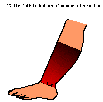 Illustration showing the 'Gaiter' area of the leg affected by venous ulceration, highlighted in red on a simple graphic of a lower leg.