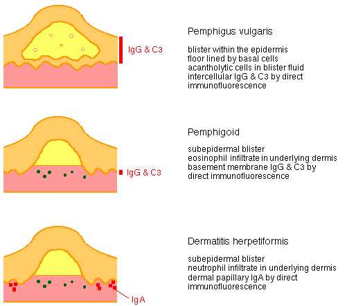 Illustrative diagrams comparing skin conditions: pemphigus vulgaris with epidermal blisters, pemphigoid showing subepidermal blisters and infiltrate in dermis, and dermatitis herpetiformis with subepidermal blisters and neutrophil infiltration, each annotated with immunological markers and descriptions.