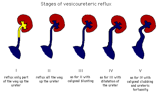 Illustration depicting five stages of vesicoureteric reflux, showing progressive severity from stage I to V in urinary systems.
