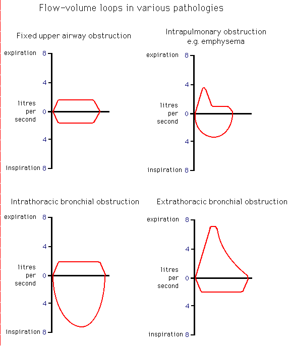 Graphical comparison of flow-volume loops for different respiratory pathologies: fixed upper airway obstruction, intrapulmonary obstruction (emphysema), intrathoracic bronchial obstruction, and extrathoracic bronchial obstruction.