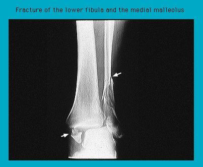 X-ray image showing a fracture of the lower fibula and the medial malleolus with arrows indicating the location of the injuries