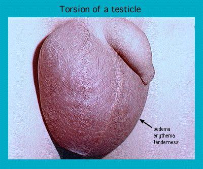 Close-up photo of a testicle affected by torsion, showing signs of edema, erythema, and tenderness indicated by an arrow.