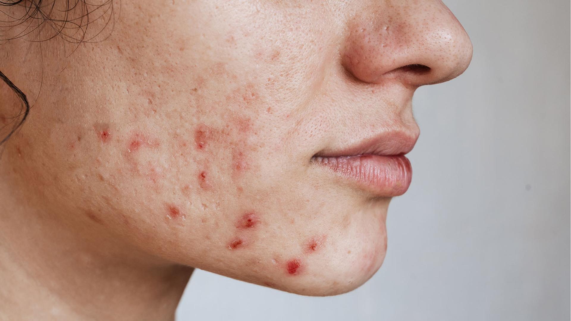 Profile view of a person's face with acne, redness, and scarring.