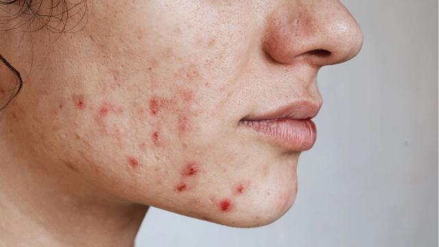 Profile view of a person's face with acne, redness, and scarring.