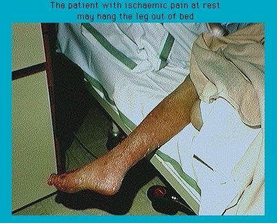 Patient's leg with ischemic pain hanging out of bed, illustrating a medical condition where pain causes the need to dangle the limb for relief.