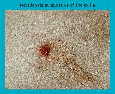 Close-up image of a skin condition called hidradenitis suppurativa in the armpit area showing inflamed nodule and hair.