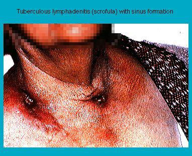 Close-up of tuberculous lymphadenitis (scrofula) with sinus formation on a person's neck