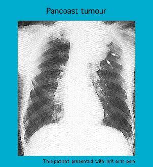 X-ray showing a Pancoast tumor with noticeable abnormal mass in the upper lung nær the spine in a patient who presented with left arm pain