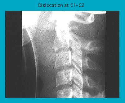 X-ray image showing dislocation at C1-C2 vertebrae in the cervical spine