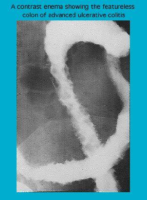 Contrast radiograph in advanced ulcerative colitis – Primary Care Notebook