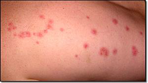 Close-up of a skin rash with multiple red spots on human skin