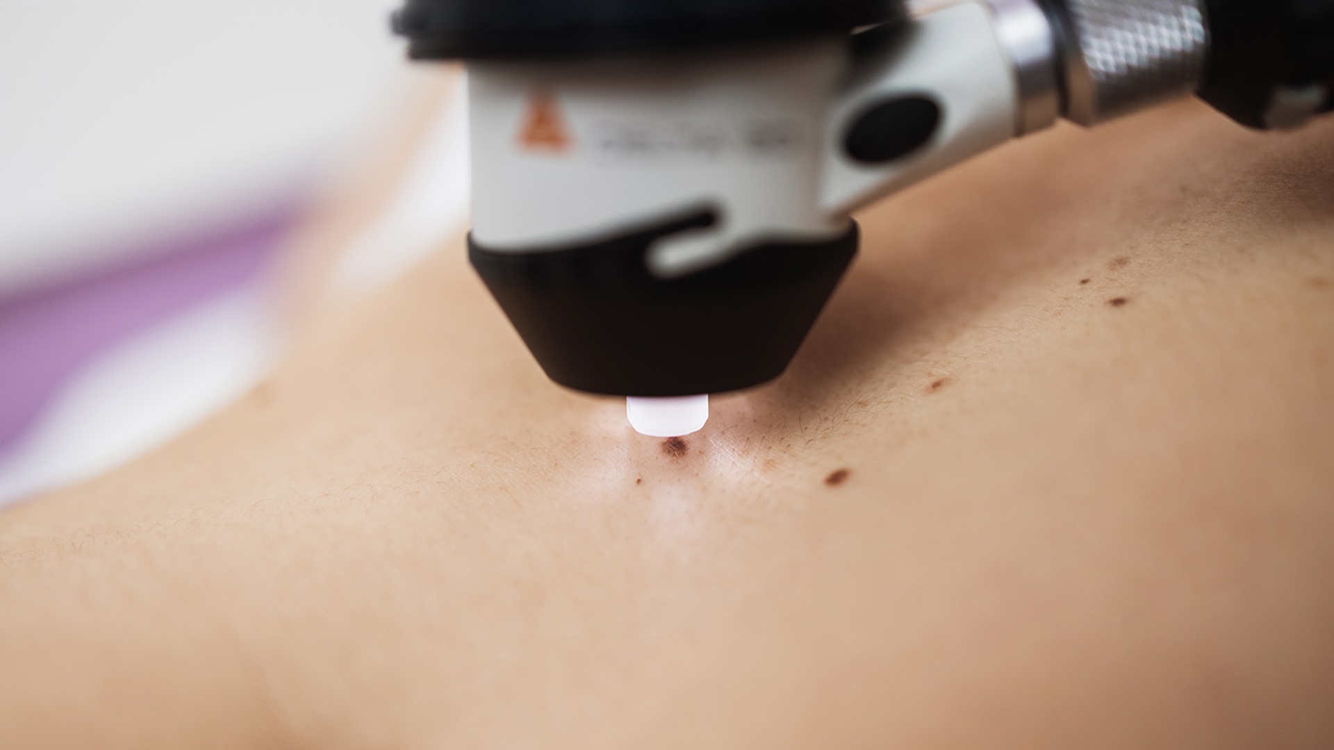 Dermatoscope examining a mole on skin.