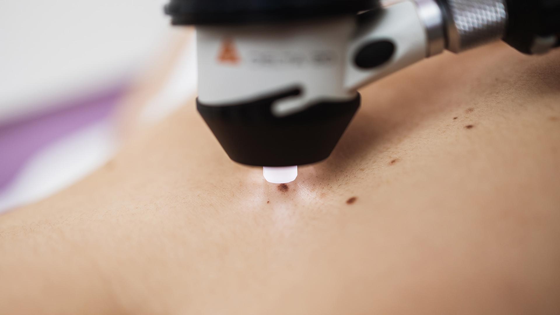 Dermatoscope examining a mole on skin.