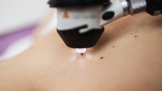 Dermatoscope examining a mole on skin.