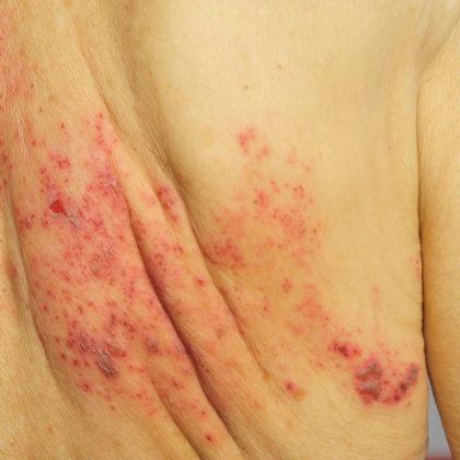Close-up view of a human skin showing allergic reaction with red rashes and blisters.