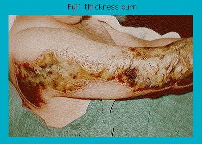Severe full thickness burn injury on a human leg showing damaged skin and tissues