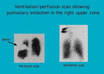 Ventilation-perfusion scan in pulmonary embolism – GPnotebook