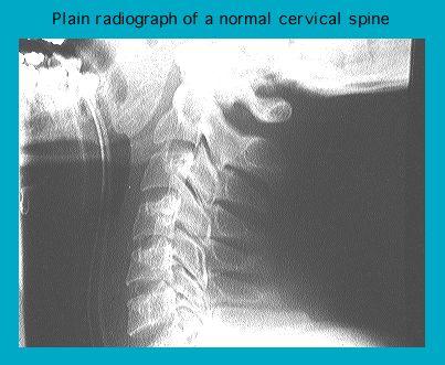 X-ray image showing the side view of a normal human cervical spine
