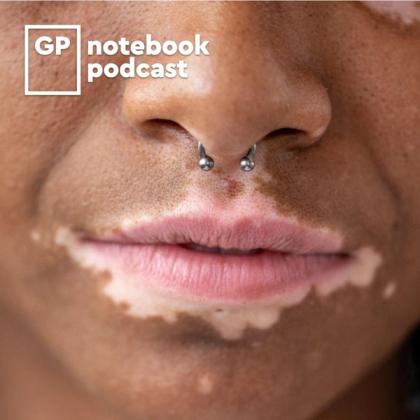 Close-up of a person's lower face with a septum piercing, vitiligo on their lips, and the logo of GP Notebook Podcast.