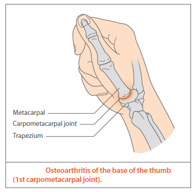 Illustration of a human hand highlighting osteoarthritis at the base of the thumb in the first carpometacarpal joint, with labeled parts including metacarpal, carpometacarpal joint, and trapezium.