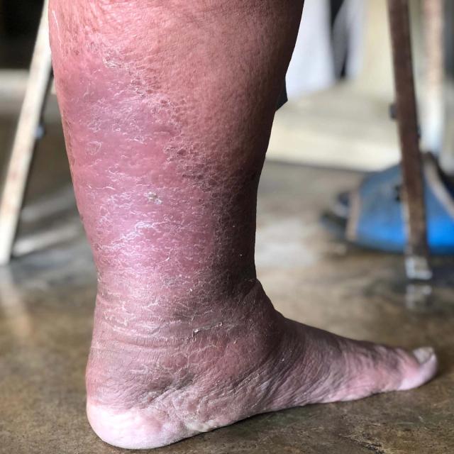 Swollen lower leg with reddish, dry, and scaly skin.