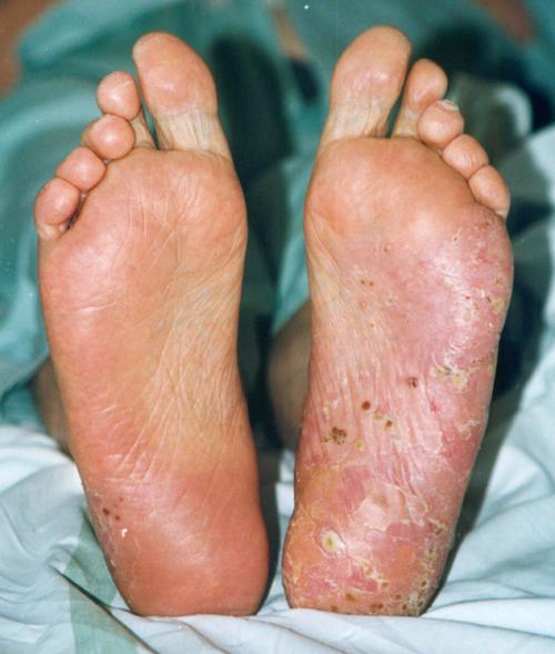 Close-up view of a person's feet showing symptoms of a severe skin condition with redness, scaling, and lesions.