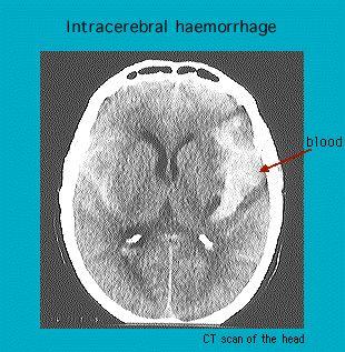 CT scan image of a head showing intracerebral hemorrhage with labeled blood accumulation.