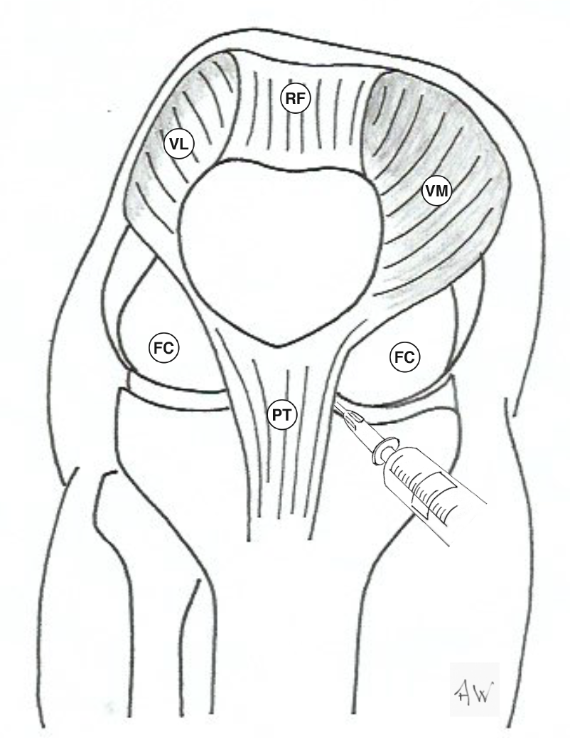 Anterior approach - aspiration or injection of the knee joint – Primary ...