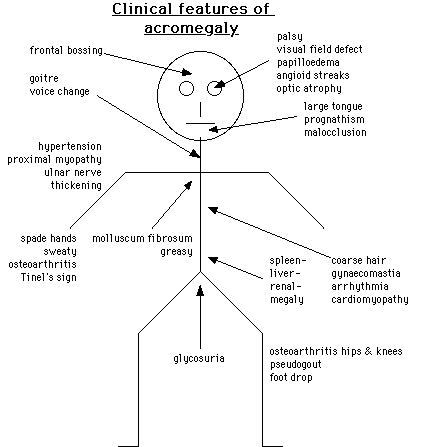 Diagram illustrating the clinical features of acromegaly, including symptoms related to various body parts such as frontal bossing, goitre, hypertension, enlarged tongue, and joint issues.