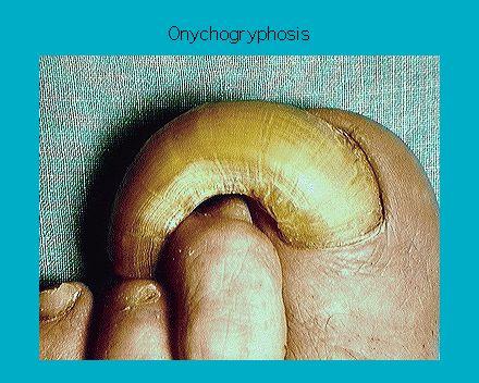 Close-up of a toe with onychogryphosis showing an extremely thick and curved toenail