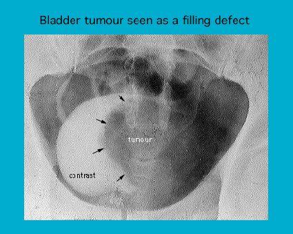 X-ray image showing a bladder tumor identified as a filling defect, with annotations highlighting the tumor area and contrast medium.