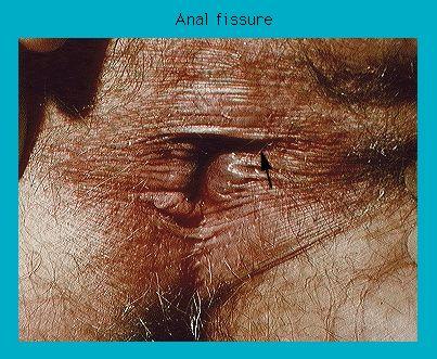 Close-up medical image of an anal fissure on human skin.