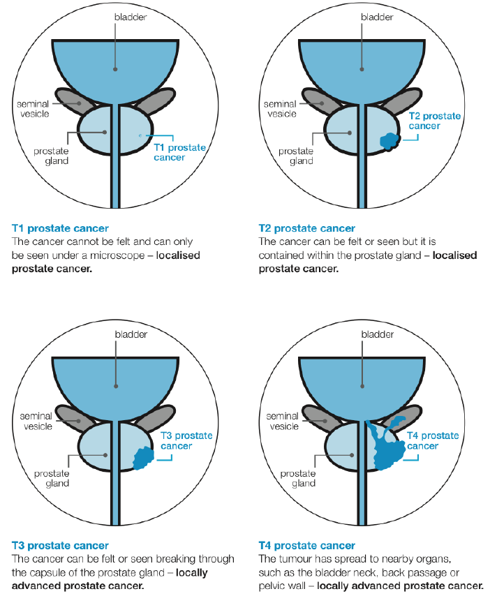 Diagram of the staging of prostate cancer – Primary Care Notebook