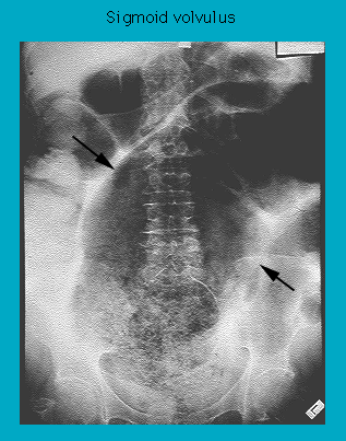 X-ray image showing sigmoid volvulus with arrows pointing to areas of concern