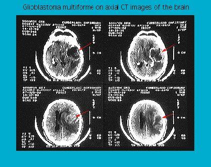 Four axial CT scan images of a brain showing areas highlighted with red arrows to indicate the presence of glioblastoma multiforme tumors.
