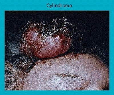Close-up of a scalp with a large cylindroma tumor, highlighting the medical condition's impact on human skin.