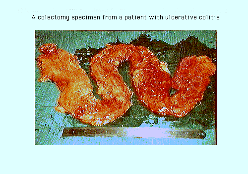 Colectomy specimen with ulcerative colitis displayed on a tray, illustrating the inflamed and ulcerated condition of the colon.