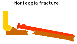 Illustration of a Monteggia fracture showing displaced ulna and radial head.