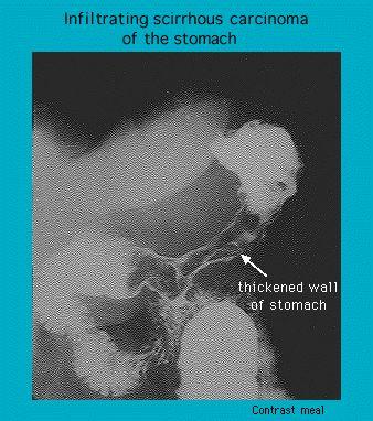 X-ray image demonstrating infiltrating scirrhous carcinoma of the stomach with a contrast meal, highlighting a thickened stomach wall indicated by an arrow.