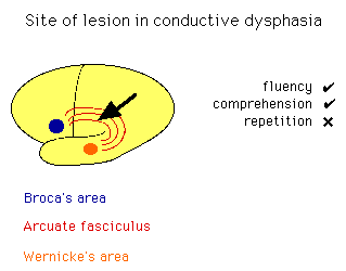 Diagram illustrating the site of lesion in conductive dysphasia within the brain, showing connections between Broca's area, Wernicke's area, and the arcuate fasciculus, marked with fluency, comprehension, and repetition indicators.