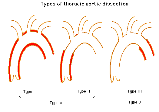 Diagram illustrating three types of thoracic aortic dissection, labeled as Type I (Type A), Type II, and Type III (Type B), each showing different extents and locations of arterial tears.