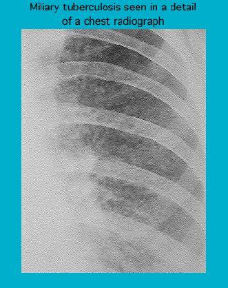Detail of a chest radiograph showing miliary tuberculosis with visible nodular patterns