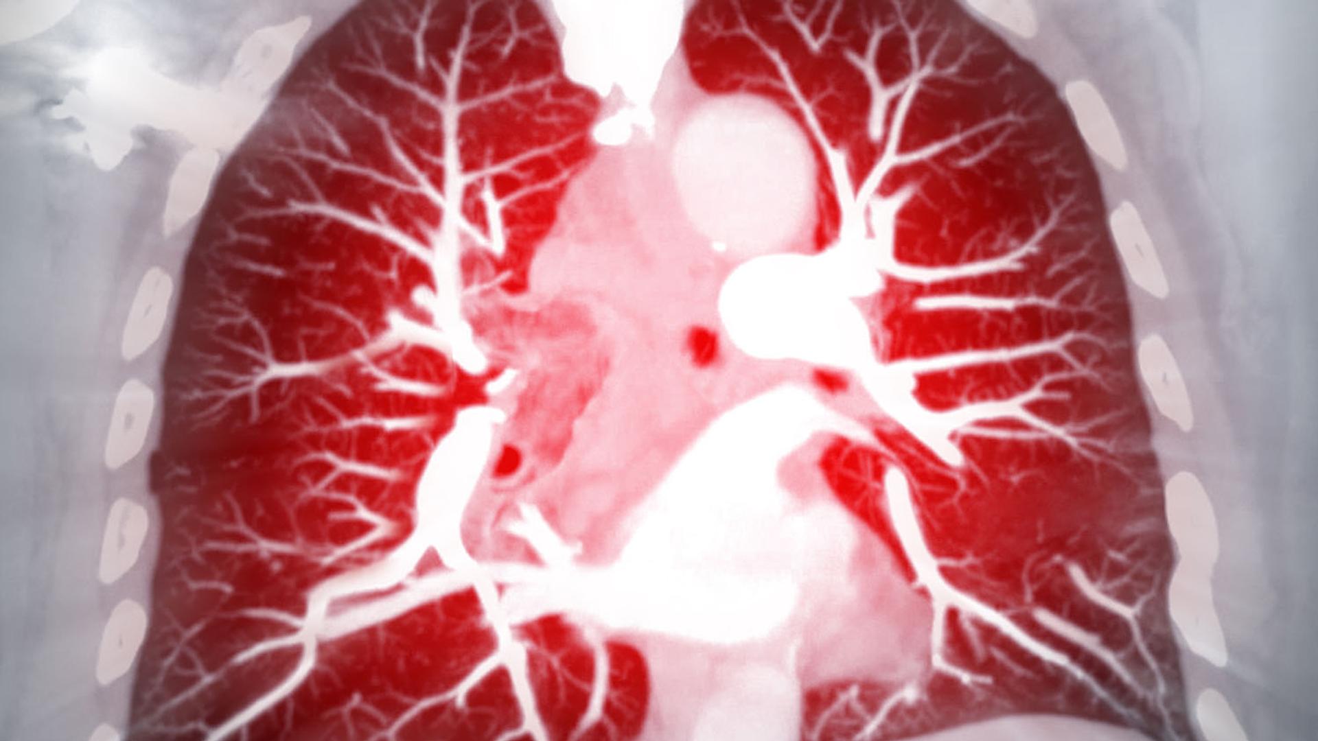 Medical scan showing human lungs and heart, with lungs highlighted in red.
