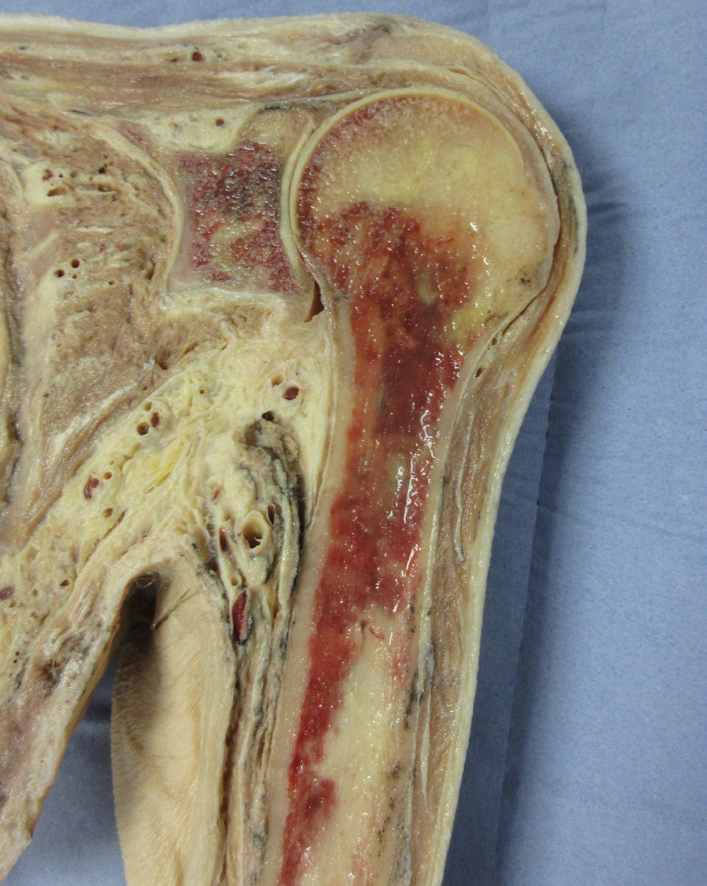 Close-up of a human knee joint dissection showing detailed internal structures and red staining indicating areas of interest for medical study.