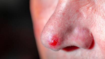 Close-up of a red, raw sore on the tip of a person's nostril.