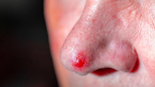 Close-up of a red, raw sore on the tip of a person's nostril.