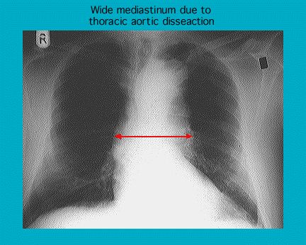 Radiographie Montrant Une Dissection De L aorte Thoracique GPnotebook radiographie-montrant-une-dissection-de-l-aorte-thoracique-gpnotebook